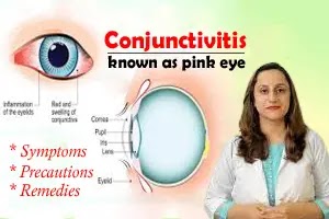 Conjunctivitis: Symptoms, Precautions and Remedies