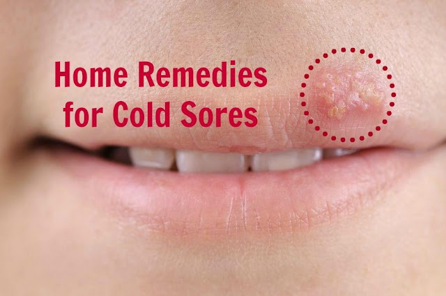 cold sores, treatment of cold sores, prevention of cold sores, home remedies for cold sores, natural remedies for cold sores, facts about cold scores, cold sores treatment, cold sores prevention, cold sores home remedies, cold sores natural remedies, cold sores facts, remedies for cold sores