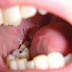 Niềng răng không nhổ răng bằng phương pháp nào?