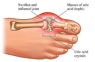 obat-asam-urat