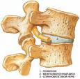 Симптомы остеохондроза
