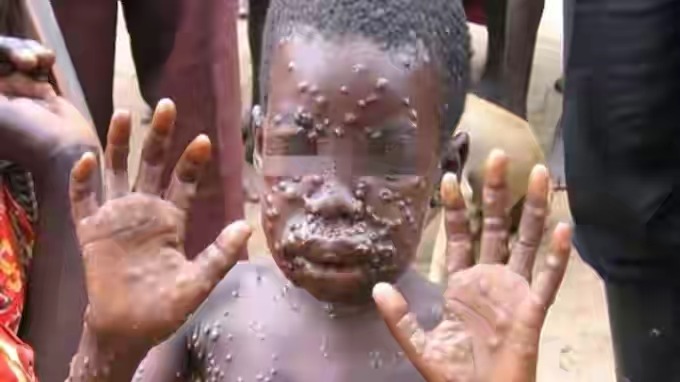 Ini tentang Monkeypox (MPX) Penyakit Cacar Monyet yang Ada di Singapura