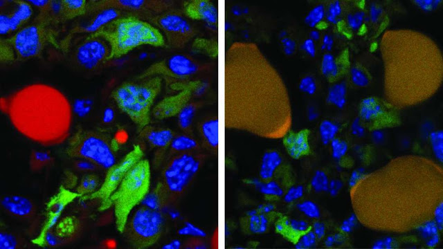 Logran convertir celulas de cancer en celulas de grasa