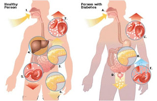 Obat Komplikasi Herbal