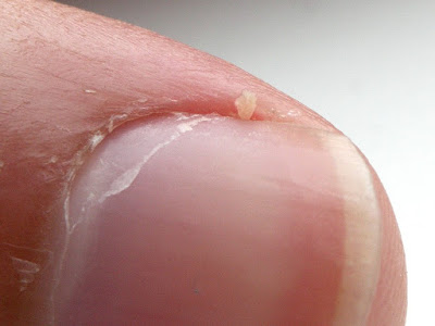 Splitting Cuticles