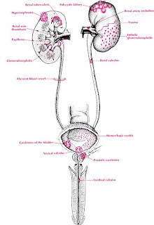 Urin Berdarah (Hematuria)