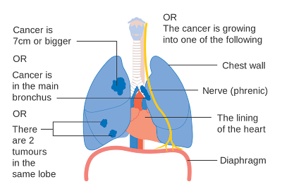 Symptoms or signs of mesothelioma