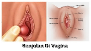 Obat Benjoan Pada bibir Vagina Jika Di Tekan Terasa Nyeri