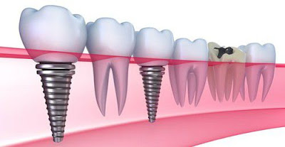 Trồng răng hàm giả bằng cấy răng implant