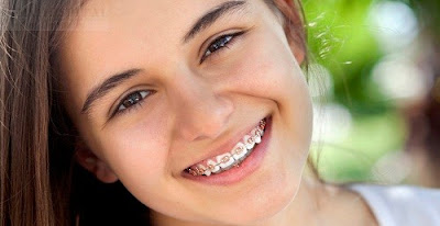 Niềng răng mất bao lâu tùy thuộc vào tình trạng của răng