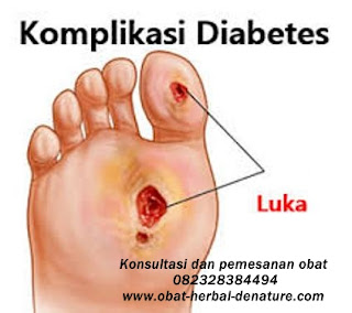 obat diabetes militus,obat herbal diabetes,obat diabetes herbal,cara mengobati diabetes secara herbal,pengobatan diabetes secara herbal,pengobatan diabetes tanpa resep dokter