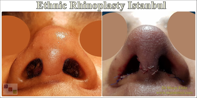 Kalın Derili Burun Estetiği - Kalın Derili Rinoplasti -  Etnik Revizyon Burun Estetiği  - Tersiyer Revizyon Etnik Burun Estetiği - Kalın Derili Revizyon Rinoplasti - Kalın Derili Revizyon Burun Estetiği