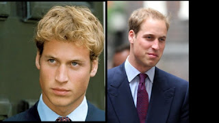 Prince William Hair Loss