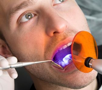 Laser Tech là công nghệ trám răng cho kết quả tốt nhất hiện nay 
