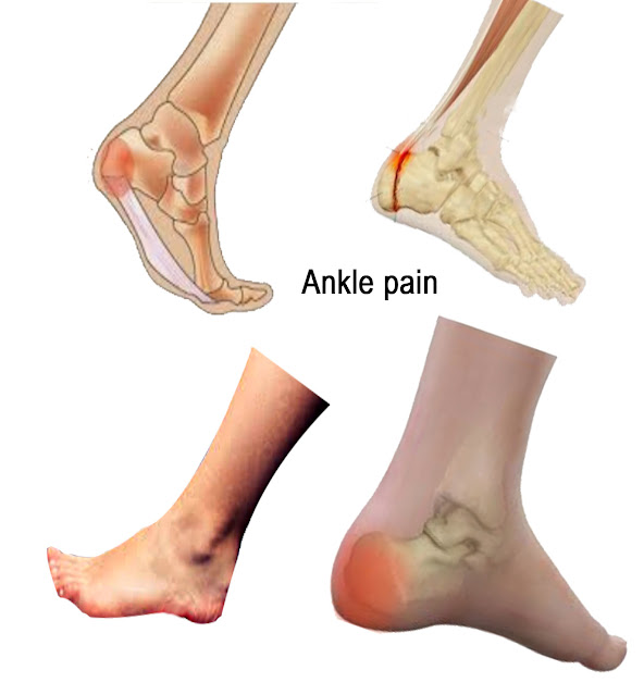 Ankle pain.