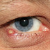 EARLY SIGNS OF EYE PROBLEMS 