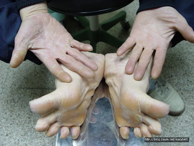 한쪽 손과 양쪽 발에 생긴 백선증 병변 이미지