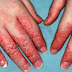 Eczema Causes,Symptoms,Home Remedies