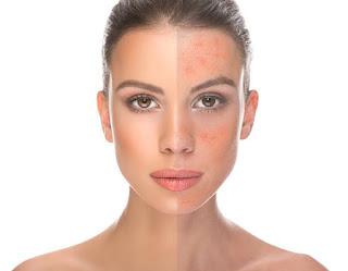 Rosacea Clinic in Manchester near Me
