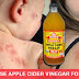 How To Treat Eczema Effectively And Naturally With Apple Cider Vinegar