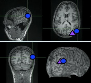 Junção temporo-parietal direita