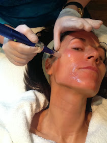 SkinPen Review, SkinPen Dallas, SkinPen Treatment