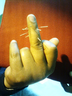 Acupuncture Needles On The Fingers Of A Patient. Sagarpur, Suburban South West Delhi.