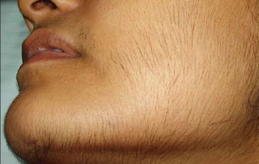 The Best Remedy To Remove Facial Hair Permanently at Home in One Day With Lemon and Sugar