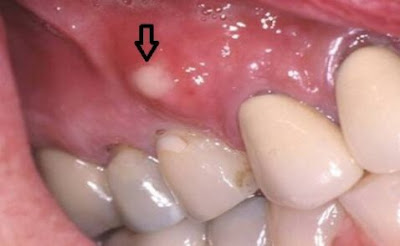 Hướng dẫn cách điều trị bệnh viêm nướu tại nhà