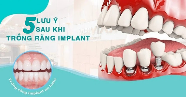 5 lưu ý sau khi trồng răng implant cần chú ý để phục hồi nhanh chóng