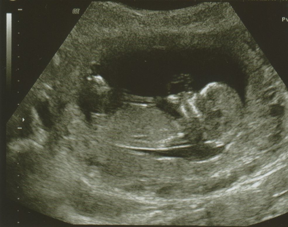 Images Of 5 Week Fetus. 2011 images of 5 week fetus.