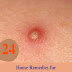 24 Home Remedies for Pustules