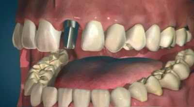 имплантация зубов и протезирование зубов