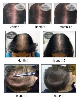 Hair Loss In Women Investigations : Chemotherapy What You Can Do To Boost Your Immune System