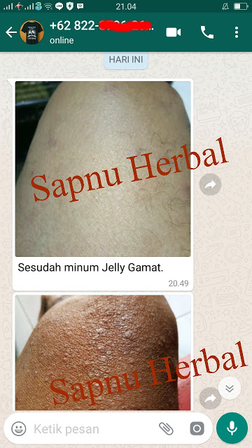 Cara Mengobati Jamur Kulit Yang Membandel Secara Alami Terbukti Mujarab ~ TESTIMONI QNC JELLY GAMAT