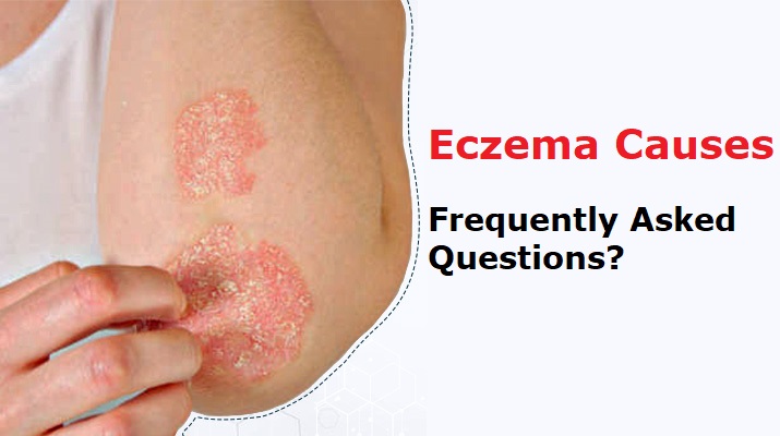 Eczema Causes Frequently Asked Questions