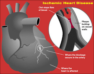 Ischemia