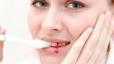 Nguyên nhân chảy máu chân răng khi mang thai mẹ bầu chưa biết 1