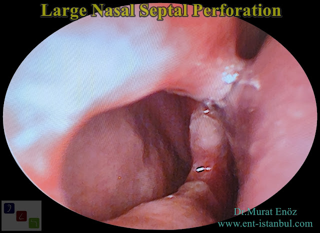 nasal septal hole closure,repairing of  septum perforation, septum perforation surgery in istanbul