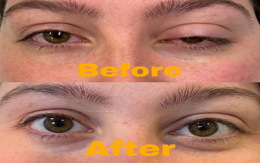 droopy eyelid Botox