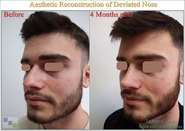 Aesthetic Reconstruction of Twisted Nose, Crooked Nose, Deviated Nose