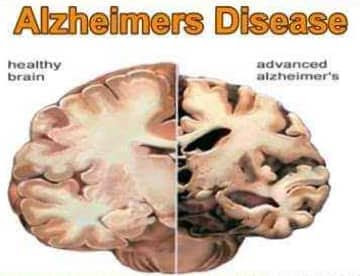 symptoms of Alzheimer