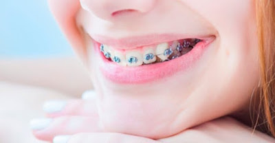 Các loại niềng răng và chi phí niềng răng 2