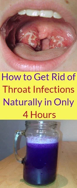 How To Get Rid Of Throat Infections Naturally In Only 4 Hours