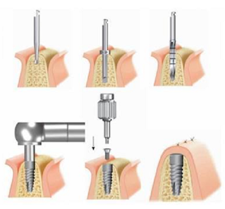 Cấy ghép răng Implant nha khoa-2