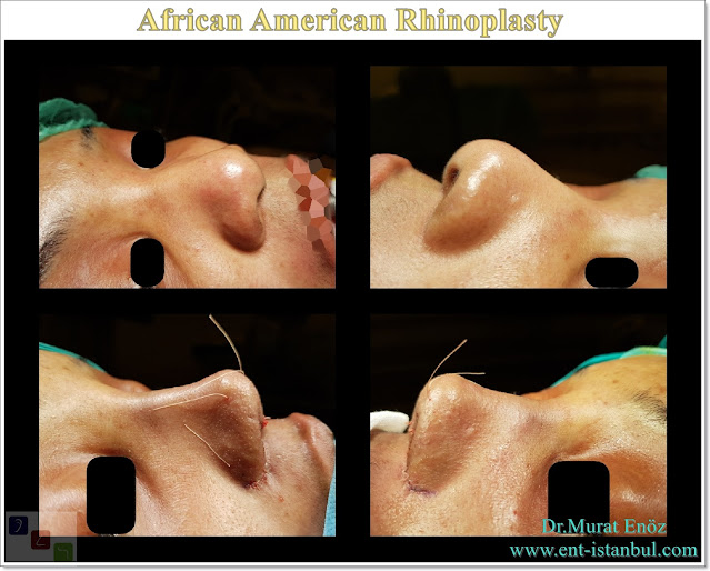 African American rhinoplasty,Thick skin nose job,Ethnic expert rhinoplasty surgeon,Black nose job,Ethnic Rhinoplasty Istanbul,