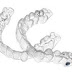 Đôi nét về niềng răng invisalign