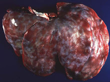 Fibrosis hepática (cerdo, milk spot)