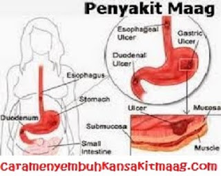 Cara alami mengatasi maag yang menahun