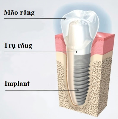 Chịu lực tức thì trên Implant